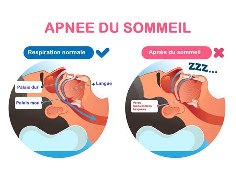 Prise de sang, analyses & apnée du sommeil à Québec .